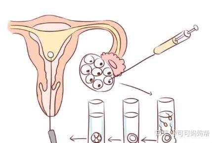女性人工助孕