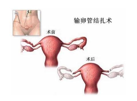 人工授精